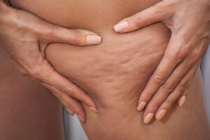 cellulite reduction