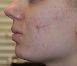 hydrfacial and Venus viva