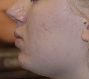 hydrafacial and Venus viva