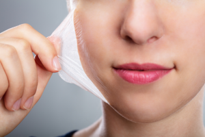 chemical peel