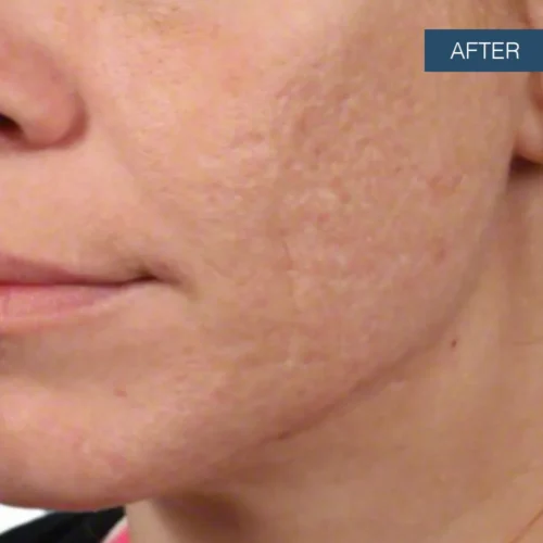 After treatment photo showcasing improved skin texture and reduced appearance of acne scars achieved through professional treatments at Make You Well.