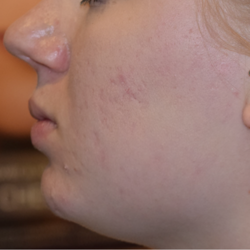 After treatment photo showcasing improved skin texture and reduced appearance of acne scars achieved through professional treatments at Make You Well.