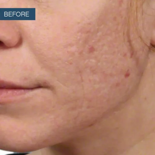 Before treatment photo showing the initial skin texture for a patient seeking professional acne scar reduction services at Make You Well.