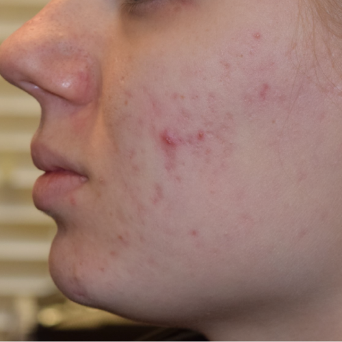Before treatment photo showing the initial skin texture for a patient seeking professional acne scar reduction services at Make You Well.