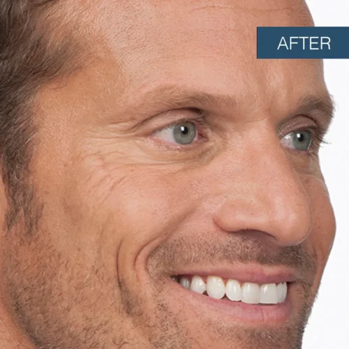 After treatment photo of Stephen, showcasing smoothed lines and a refreshed, natural appearance achieved through professional Botox services at Make You Well.