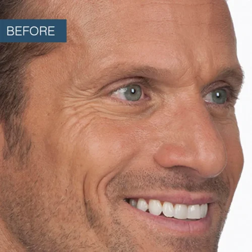 Before treatment photo of Stephen, capturing his natural appearance prior to receiving professional Botox services for facial rejuvenation at Make You Well.