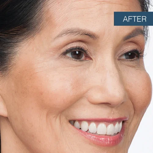 After treatment photo of Susan, showcasing smoothed lines and refreshed facial rejuvenation results achieved with professional Botox at Make You Well.