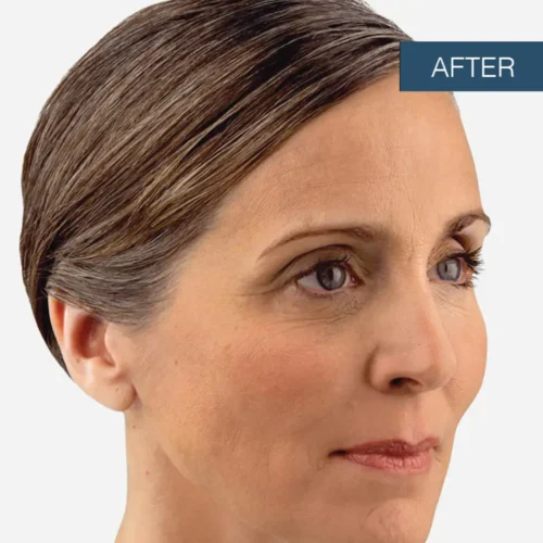 After treatment view of a patient’s cheeks, showcasing the rejuvenated and lifted results achieved through professional facial filler treatment at Make You Well.