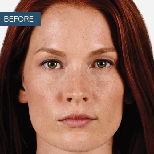 Before treatment view of a patient’s lips, showcasing the initial assessment for natural lip enhancement through professional filler services at Make You Well.