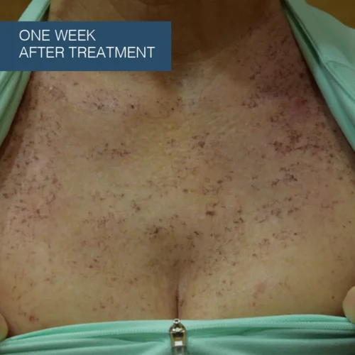 Results showing the skin's progress one week after professional sun damage treatment at Make You Well.