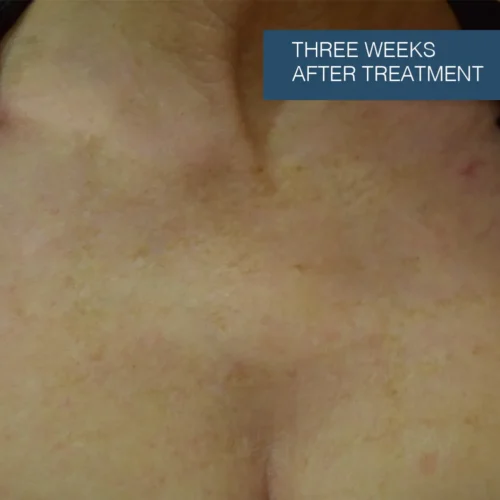Results showing visible improvement and skin healing three weeks after professional sun damage treatment at Make You Well.