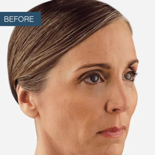 Before treatment view of a patient's cheek area, showcasing the initial assessment for wrinkle reduction and facial rejuvenation at Make You Well.